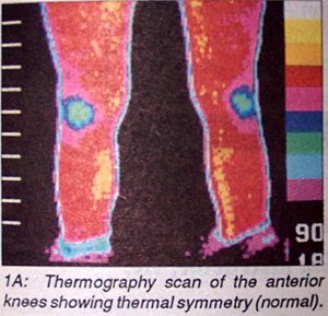 Thermography scan of the anterior knees - Copyright – Stock Photo / Register Mark