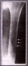 X-ray of humerus 2 - Copyright – Stock Photo / Register Mark