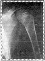 X-Ray of humerus 1 - Copyright – Stock Photo / Register Mark