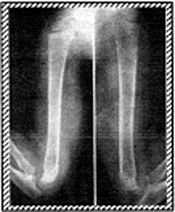 X-Ray of humerus 3 - Copyright – Stock Photo / Register Mark