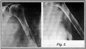 X-Ray of humerus 4 - Copyright – Stock Photo / Register Mark