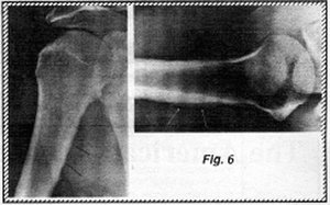 X-Ray of humerus 5 - Copyright – Stock Photo / Register Mark