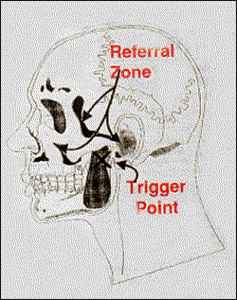 Referral Zone and Trigger Point Diagram - Copyright – Stock Photo / Register Mark