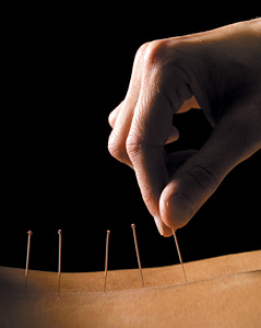 acupuncture on back - Copyright – Stock Photo / Register Mark
