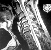 MRI study obtained after the chair incident. - Copyright – Stock Photo / Register Mark