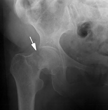 neck of femur fracture - Copyright – Stock Photo / Register Mark