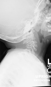 cervical extension radiograph - Copyright – Stock Photo / Register Mark