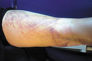 lymphatic taping - Copyright – Stock Photo / Register Mark