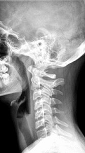 straight cervical spine - Copyright – Stock Photo / Register Mark