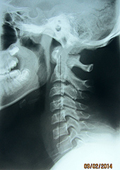 Lateral Cervical - Copyright – Stock Photo / Register Mark