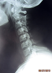Lateral Cervical - Copyright – Stock Photo / Register Mark