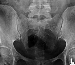 PA view of the sacrum - Copyright – Stock Photo / Register Mark