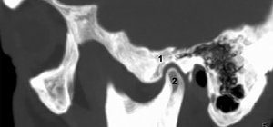 Oblique sagittal CT of TMJ - Copyright – Stock Photo / Register Mark