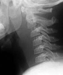 Pediatric C spine - Copyright – Stock Photo / Register Mark