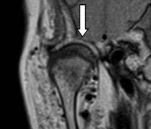 Coronal MRI PD image of the TMJ - Copyright – Stock Photo / Register Mark