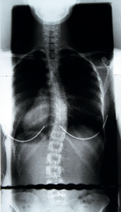 scoliosis spine xray - Copyright – Stock Photo / Register Mark