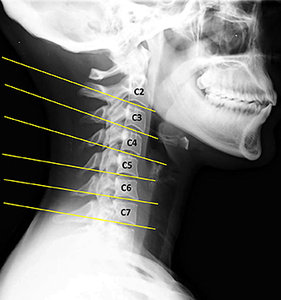 Lateral cervical view of text neck - Copyright – Stock Photo / Register Mark